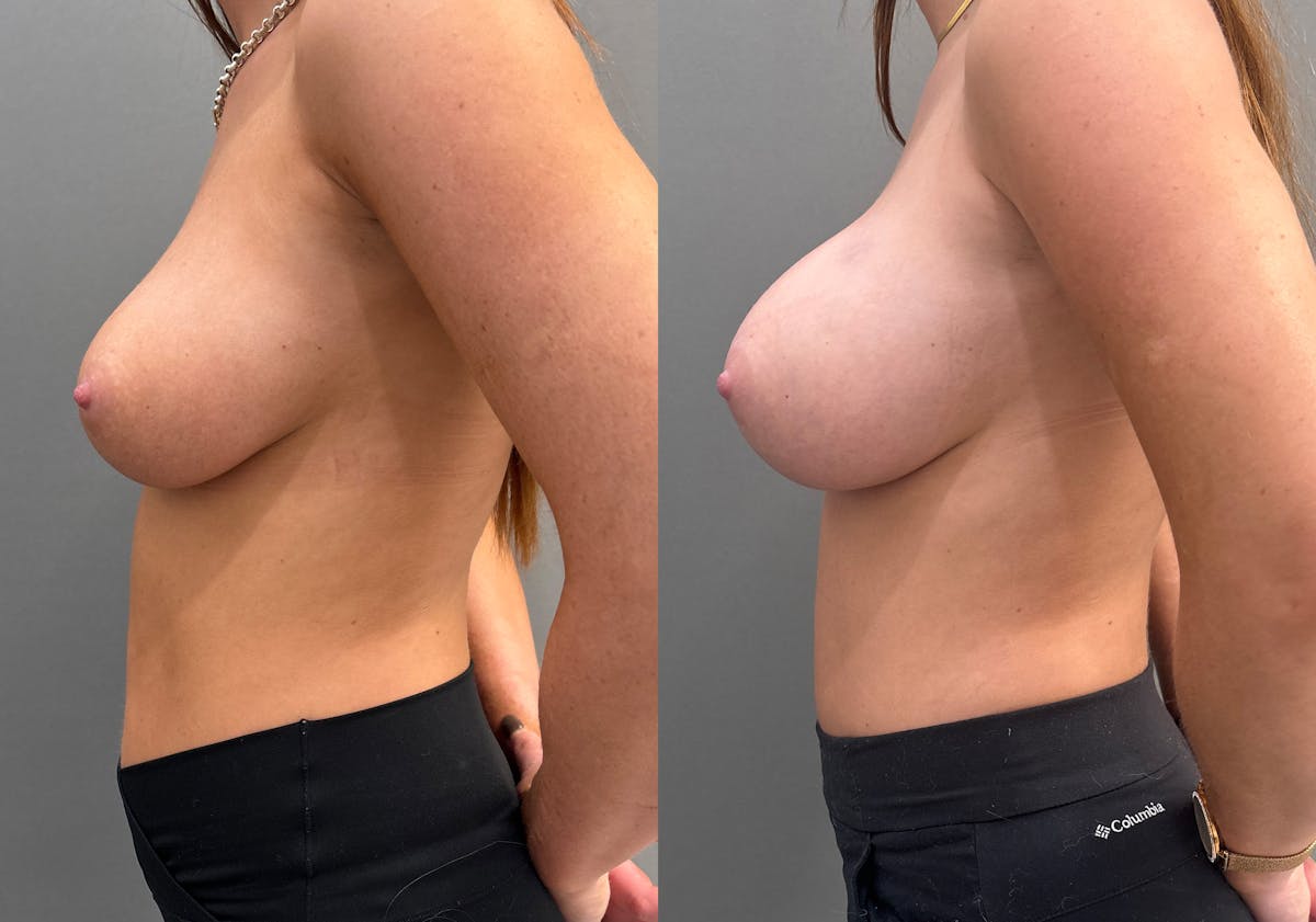 Breast Augmentation Before & After Gallery - Patient 271412 - Image 5