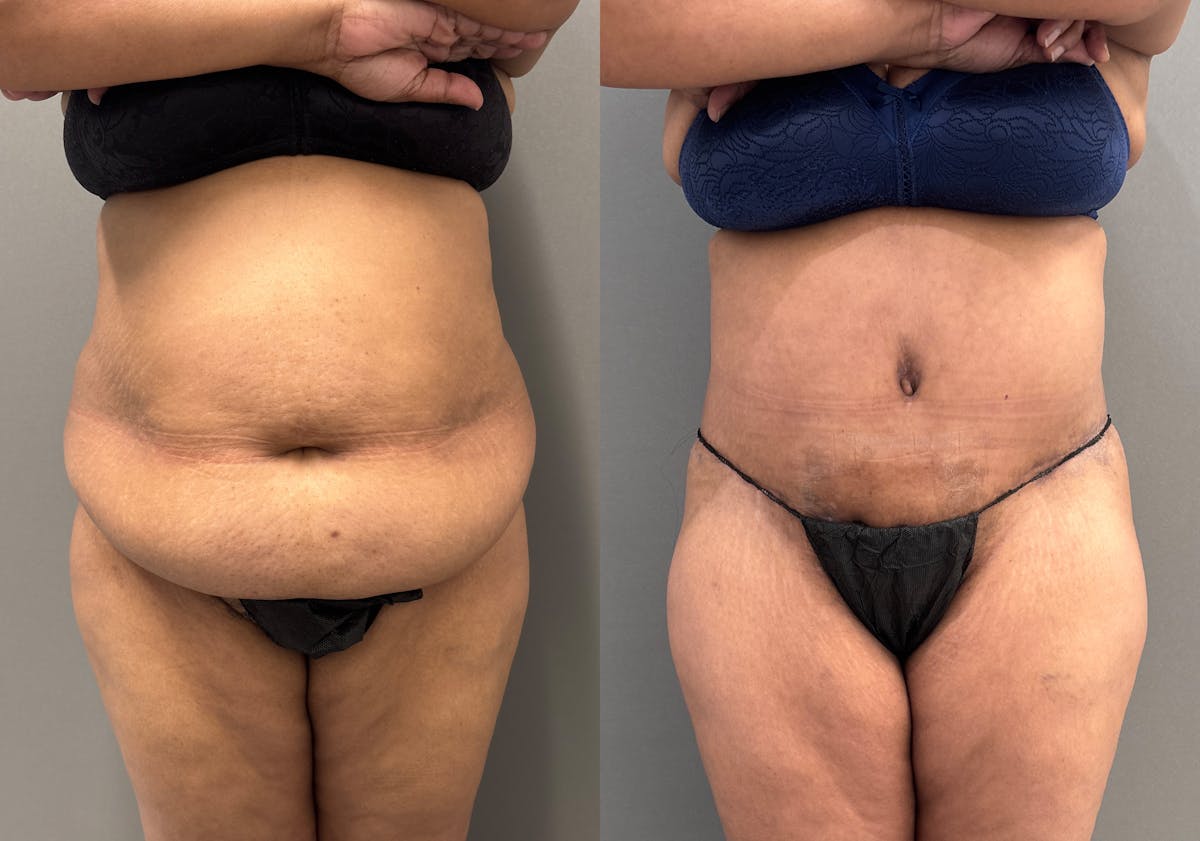 Liposuction Before & After Gallery - Patient 399149 - Image 1