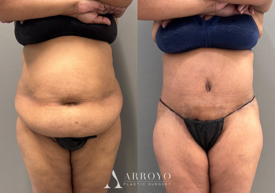 Tummy Tuck Before & After Gallery - Patient 279696 - Image 1