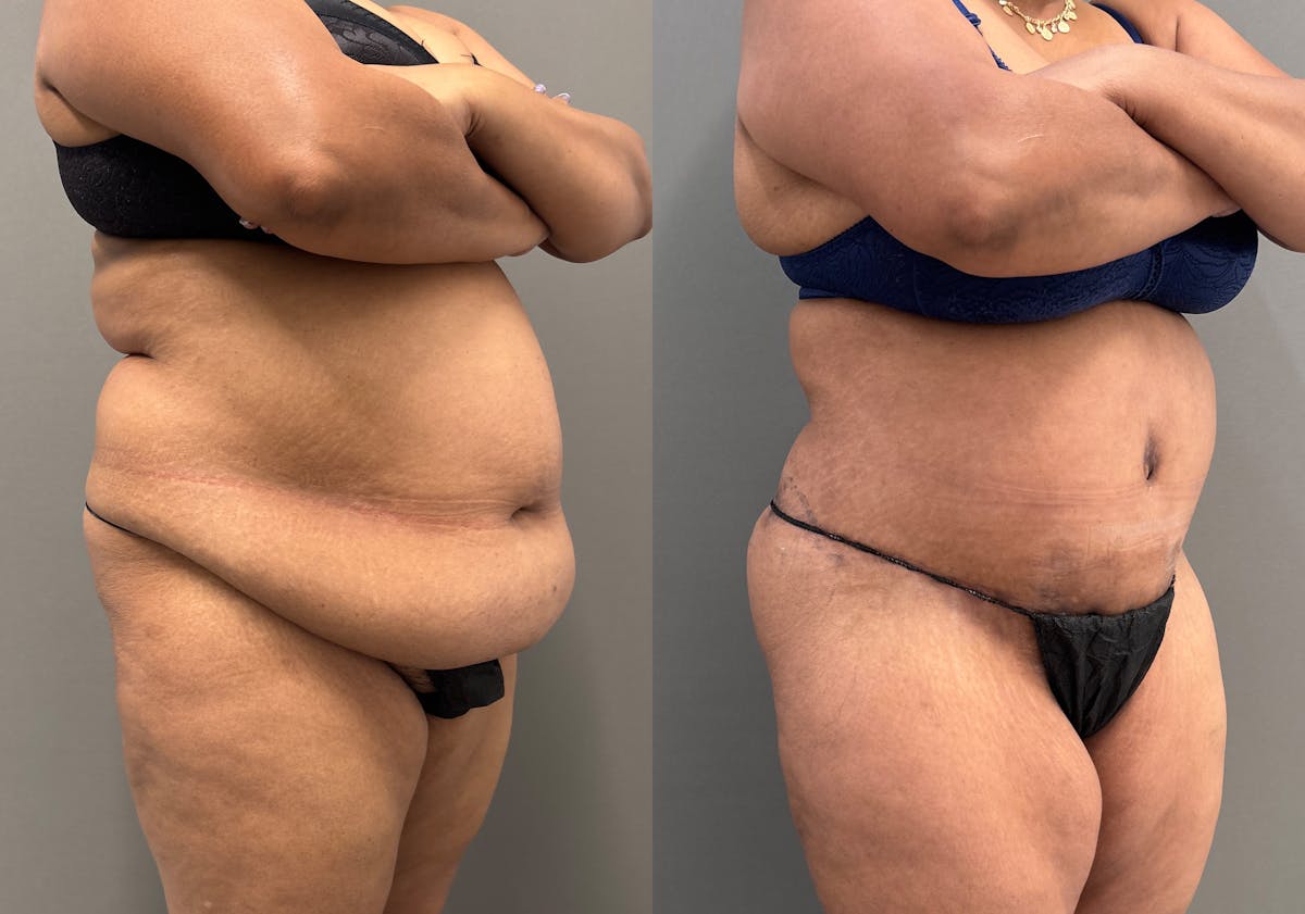 Liposuction Before & After Gallery - Patient 399149 - Image 2