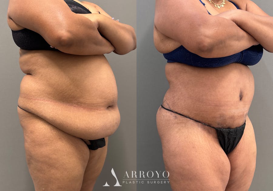 Tummy Tuck Before & After Gallery - Patient 279696 - Image 2