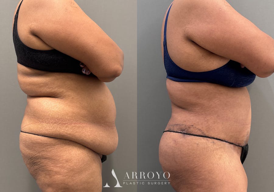 Tummy Tuck Before & After Gallery - Patient 279696 - Image 3