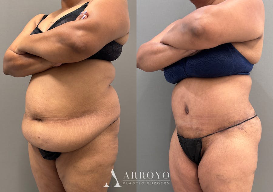 Tummy Tuck Before & After Gallery - Patient 279696 - Image 5