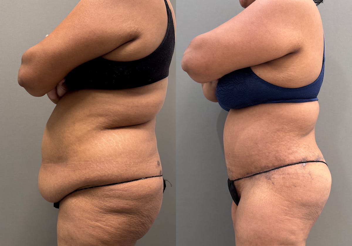 Liposuction Before & After Gallery - Patient 399149 - Image 6