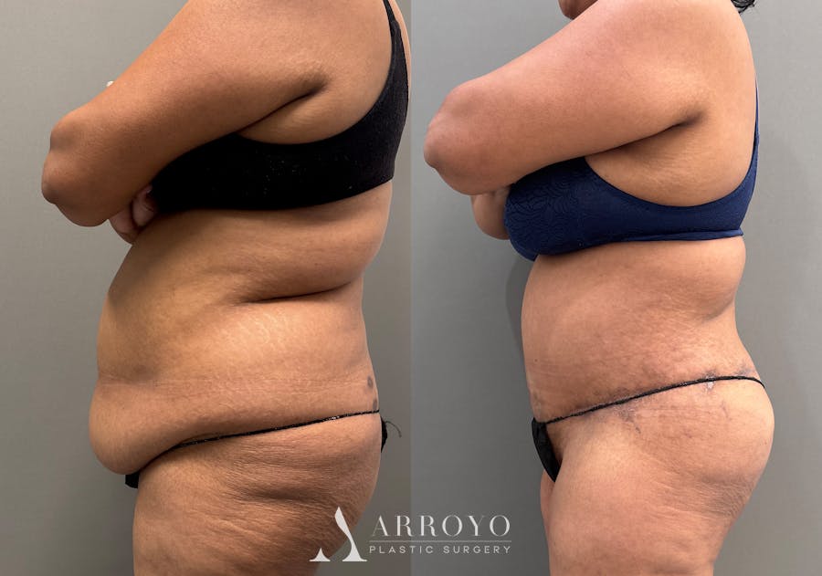 Tummy Tuck Before & After Gallery - Patient 279696 - Image 6