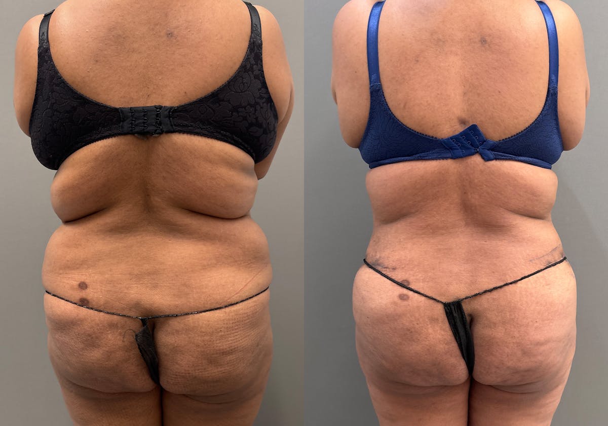 Liposuction Before & After Gallery - Patient 399149 - Image 4