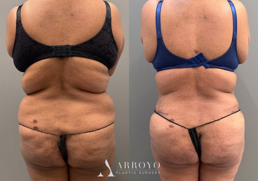Tummy Tuck Before & After Gallery - Patient 279696 - Image 4