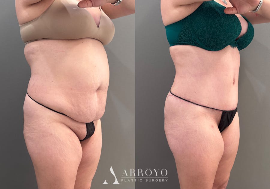 Tummy Tuck Before & After Gallery - Patient 148190 - Image 2
