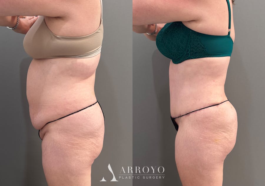 Tummy Tuck Before & After Gallery - Patient 148190 - Image 6
