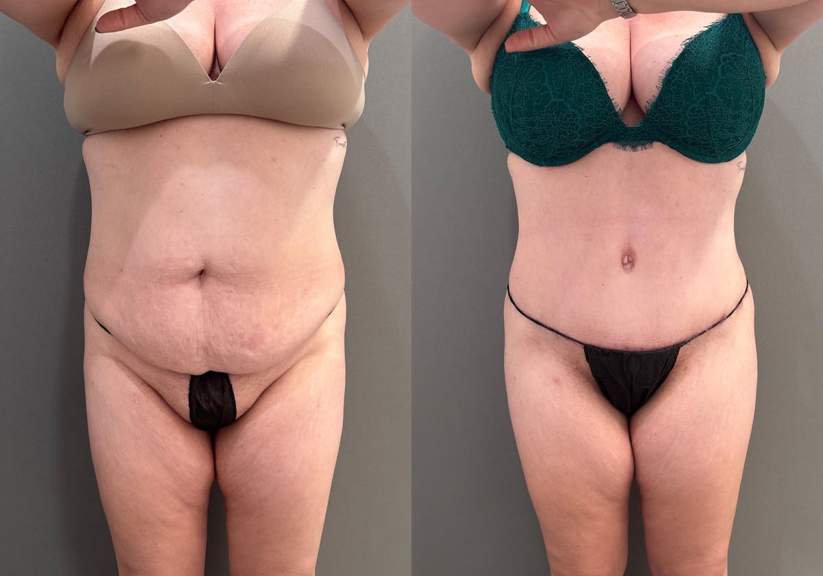 Tummy Tuck Before & After Gallery - Patient 148190 - Image 1