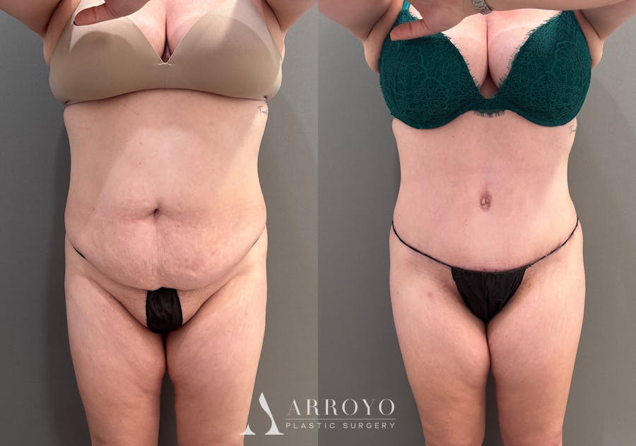 Tummy Tuck Before & After Gallery - Patient 148190 - Image 1