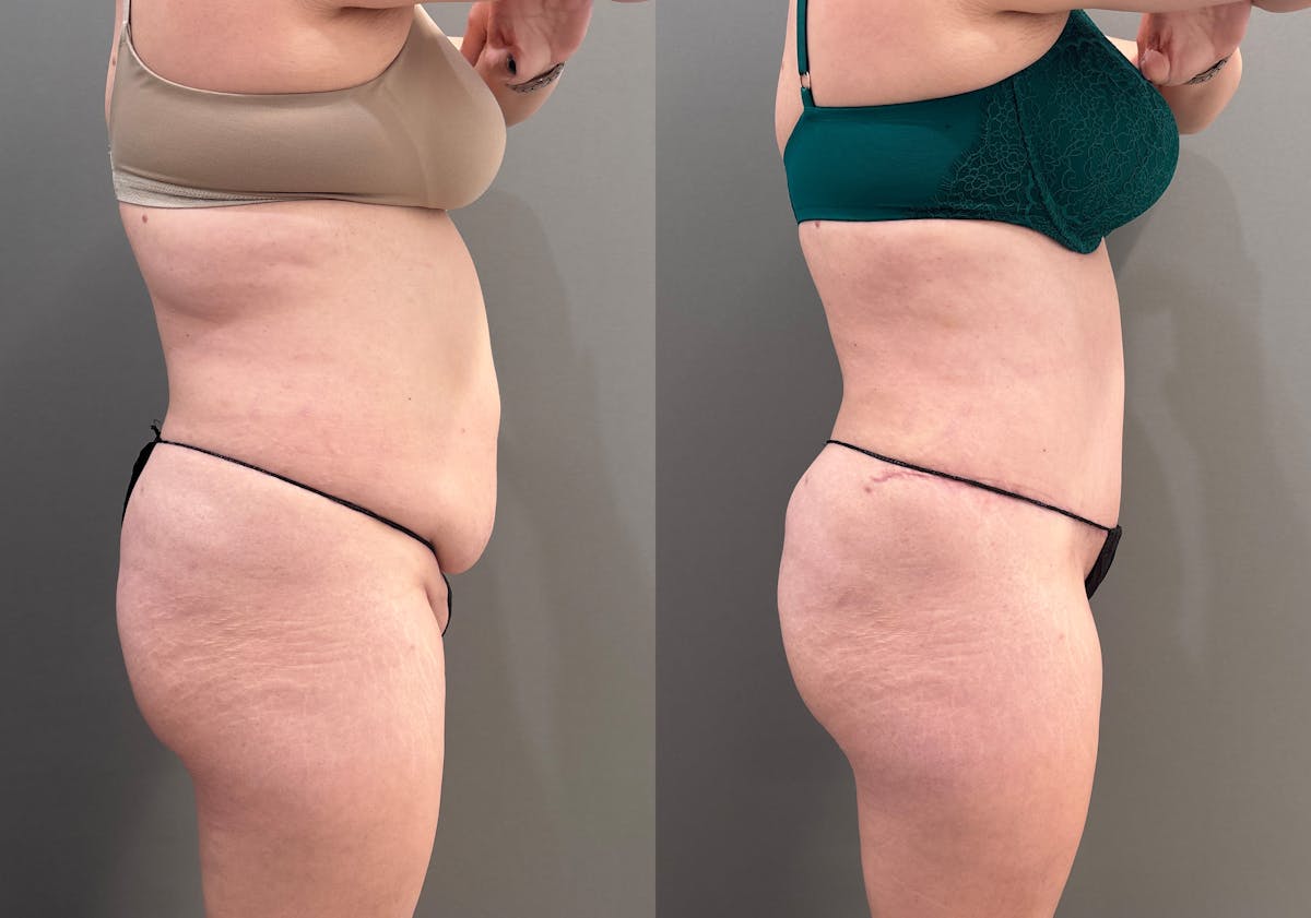 Tummy Tuck Before & After Gallery - Patient 148190 - Image 3