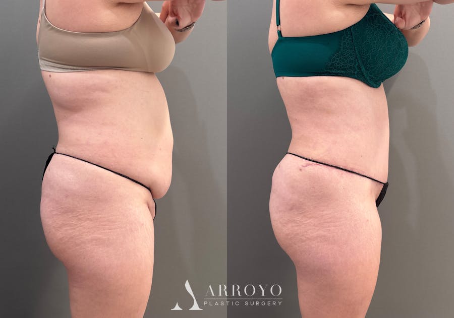 Tummy Tuck Before & After Gallery - Patient 148190 - Image 3