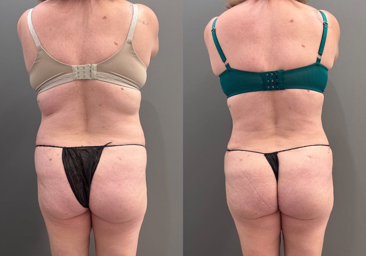 Tummy Tuck Before & After Gallery - Patient 148190 - Image 4