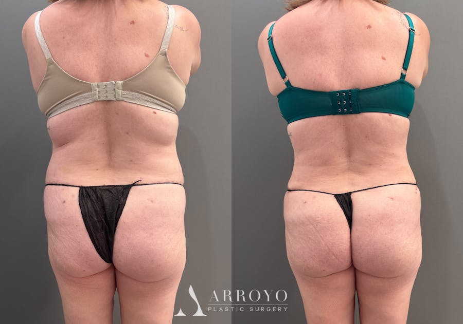 Tummy Tuck Before & After Gallery - Patient 148190 - Image 4