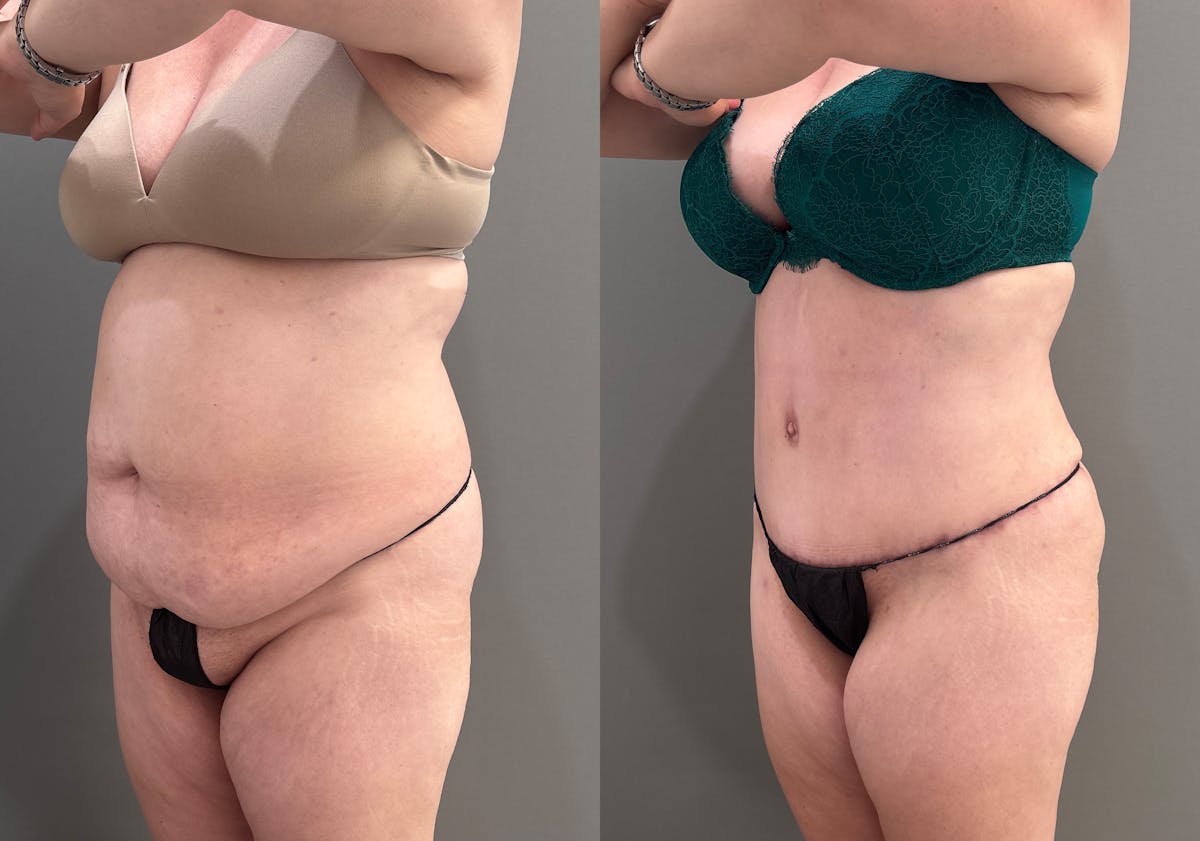 Tummy Tuck Before & After Gallery - Patient 148190 - Image 5