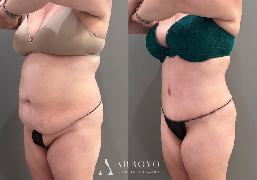 Tummy Tuck Before & After Gallery - Patient 148190 - Image 5