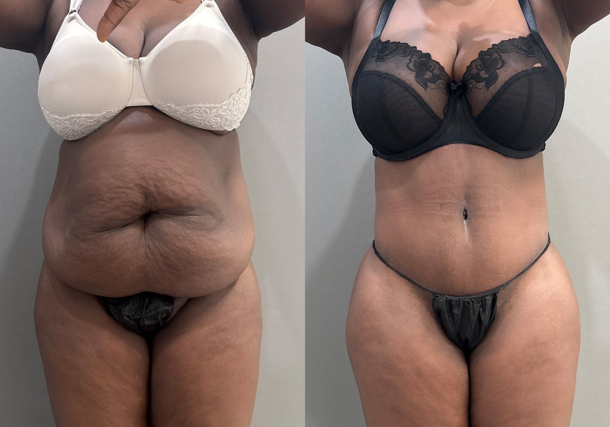 Tummy Tuck Before & After Gallery - Patient 112469 - Image 1