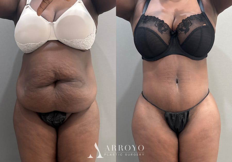 Tummy Tuck Before & After Gallery - Patient 112469 - Image 1