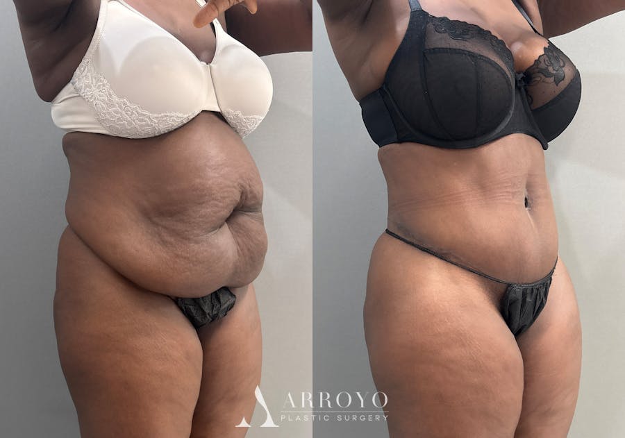 Tummy Tuck Before & After Gallery - Patient 112469 - Image 2