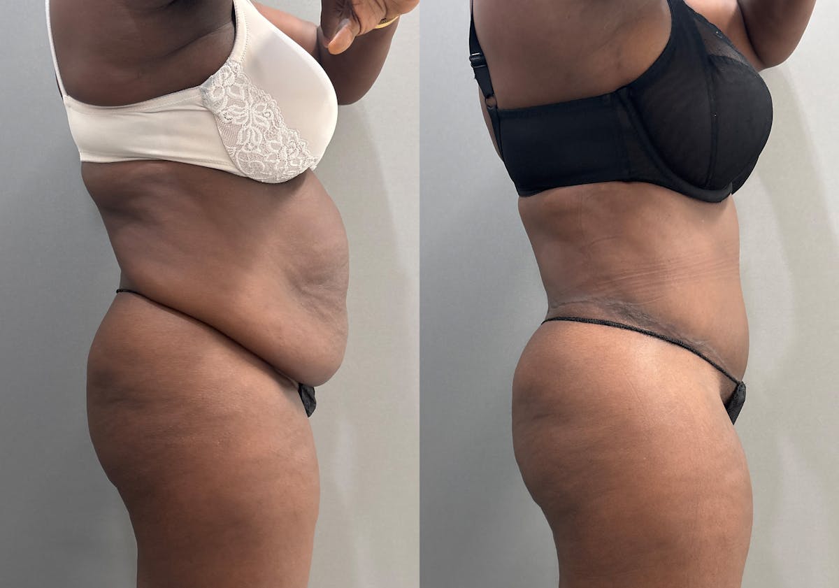 Tummy Tuck Before & After Gallery - Patient 112469 - Image 3