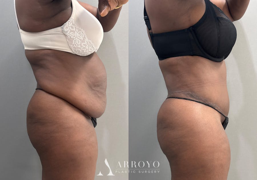 Tummy Tuck Before & After Gallery - Patient 112469 - Image 3
