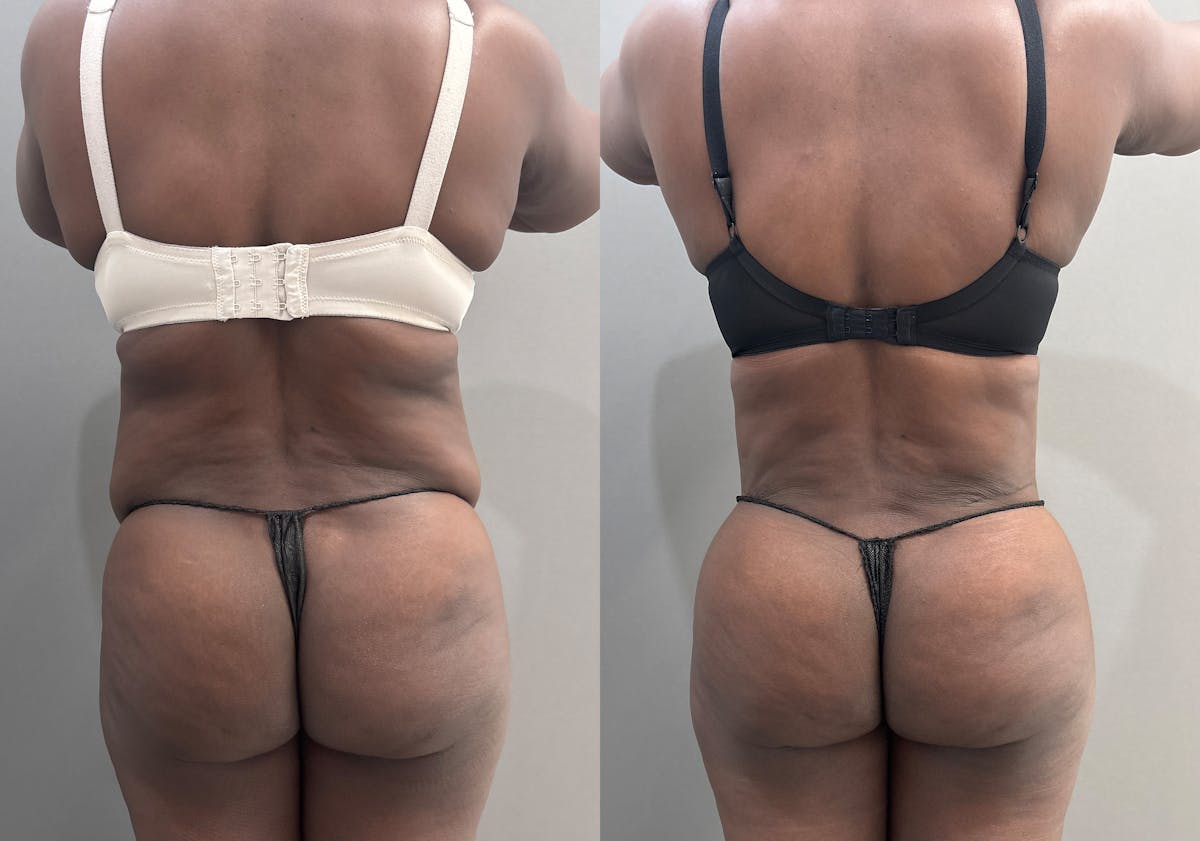 Tummy Tuck Before & After Gallery - Patient 112469 - Image 4