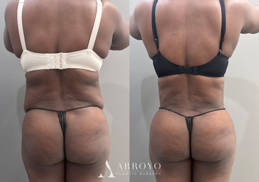 Tummy Tuck Before & After Gallery - Patient 112469 - Image 4