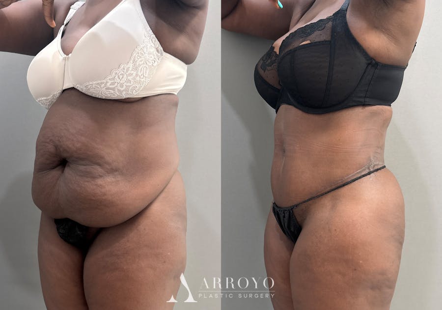 Tummy Tuck Before & After Gallery - Patient 112469 - Image 5