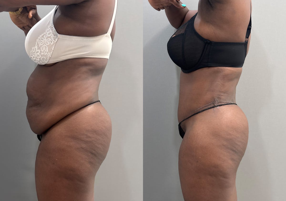 Tummy Tuck Before & After Gallery - Patient 112469 - Image 6