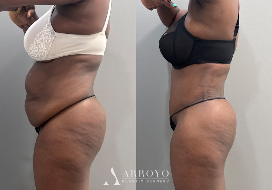 Tummy Tuck Before & After Gallery - Patient 112469 - Image 6