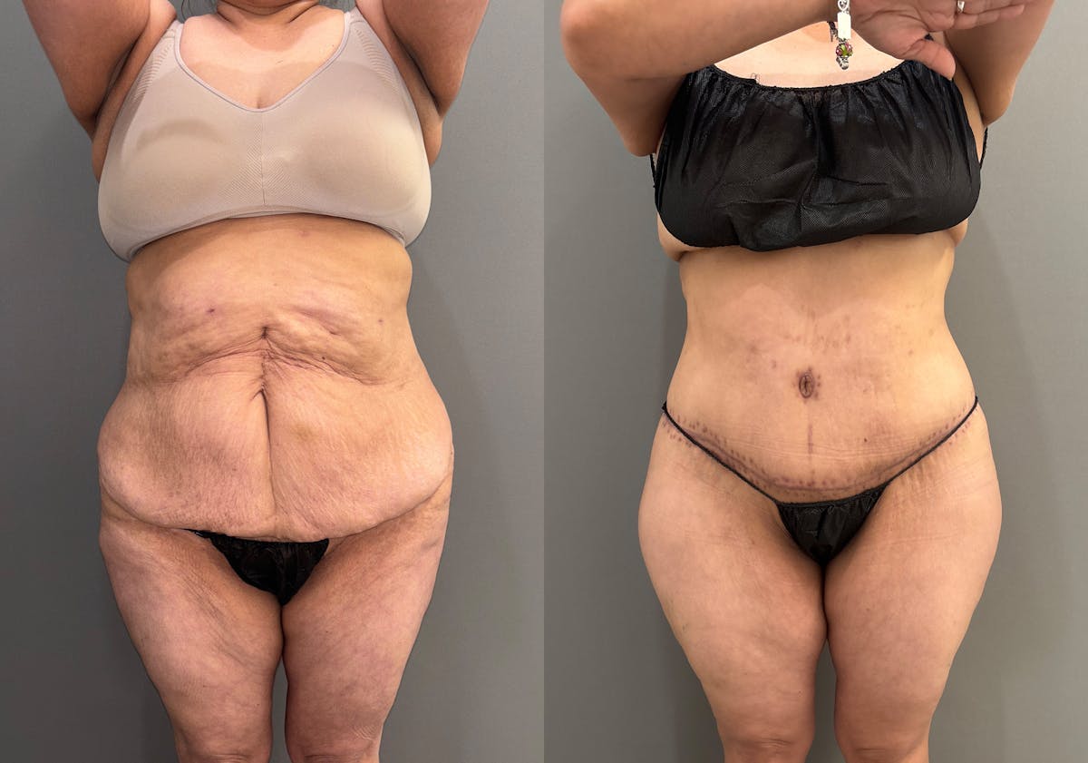 Liposuction Before & After Gallery - Patient 416071 - Image 1