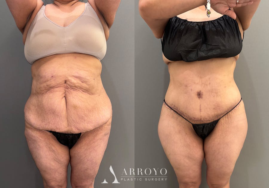 Brazilian Butt Lift Before & After Gallery - Patient 116798 - Image 4