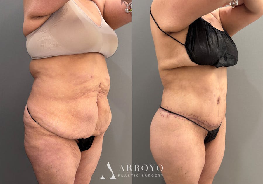 Brazilian Butt Lift Before & After Gallery - Patient 116798 - Image 3