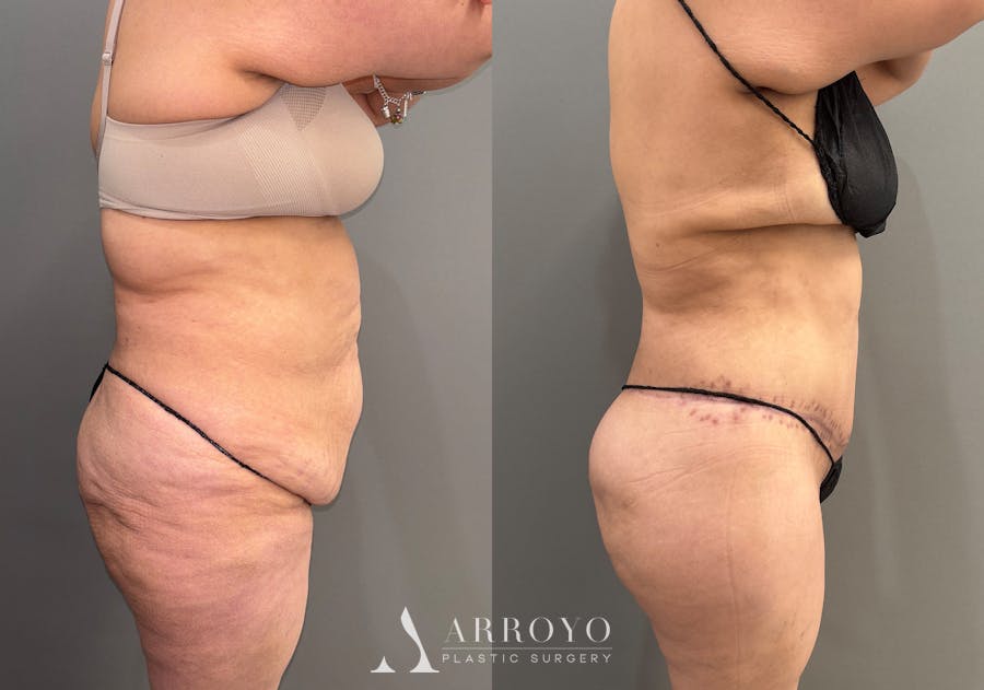 Brazilian Butt Lift Before & After Gallery - Patient 116798 - Image 2