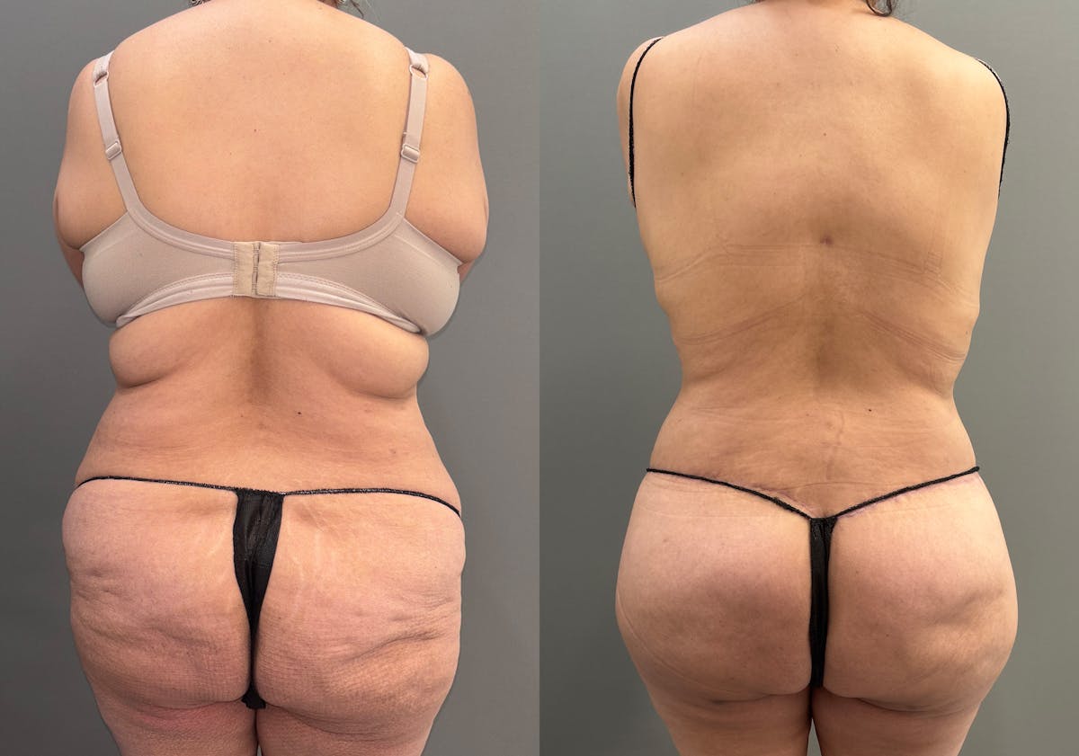 Liposuction Before & After Gallery - Patient 416071 - Image 4