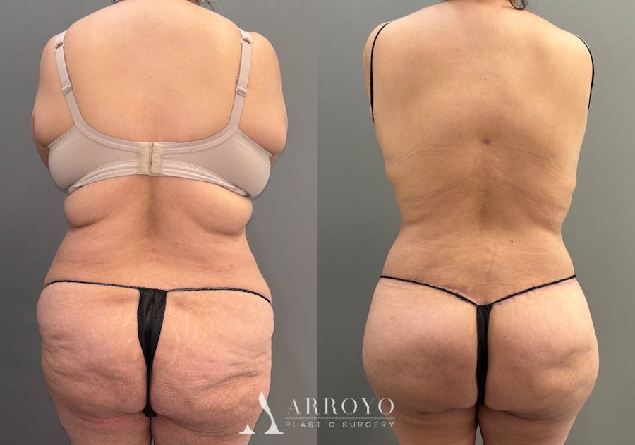 Brazilian Butt Lift Before & After Gallery - Patient 116798 - Image 1