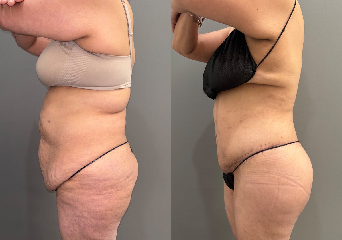 Liposuction Before & After Gallery - Patient 416071 - Image 6