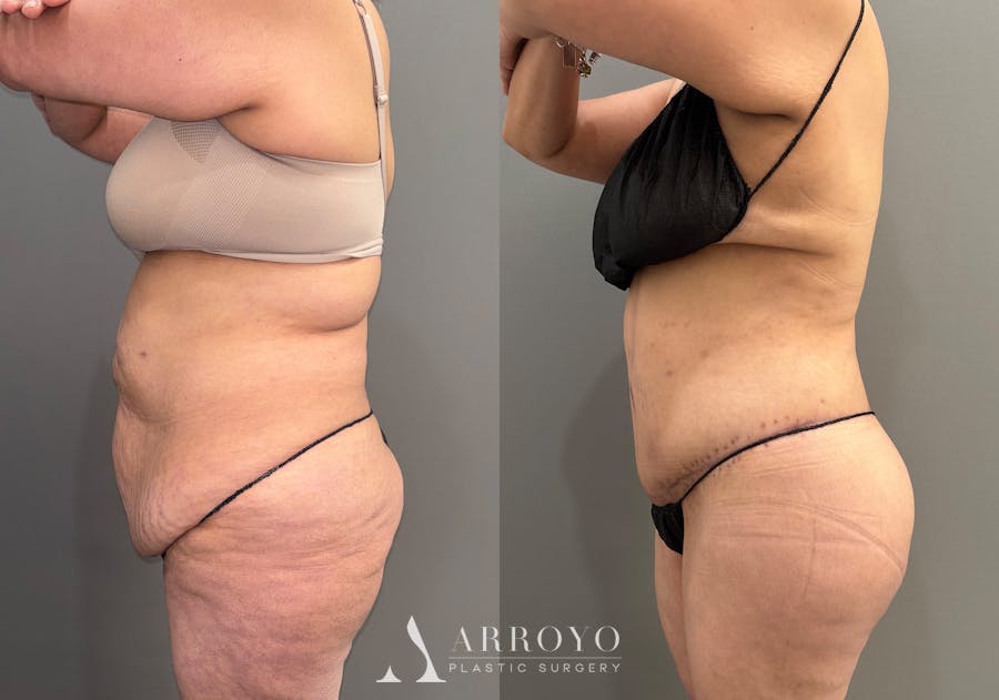 Brazilian Butt Lift Before & After Gallery - Patient 116798 - Image 6