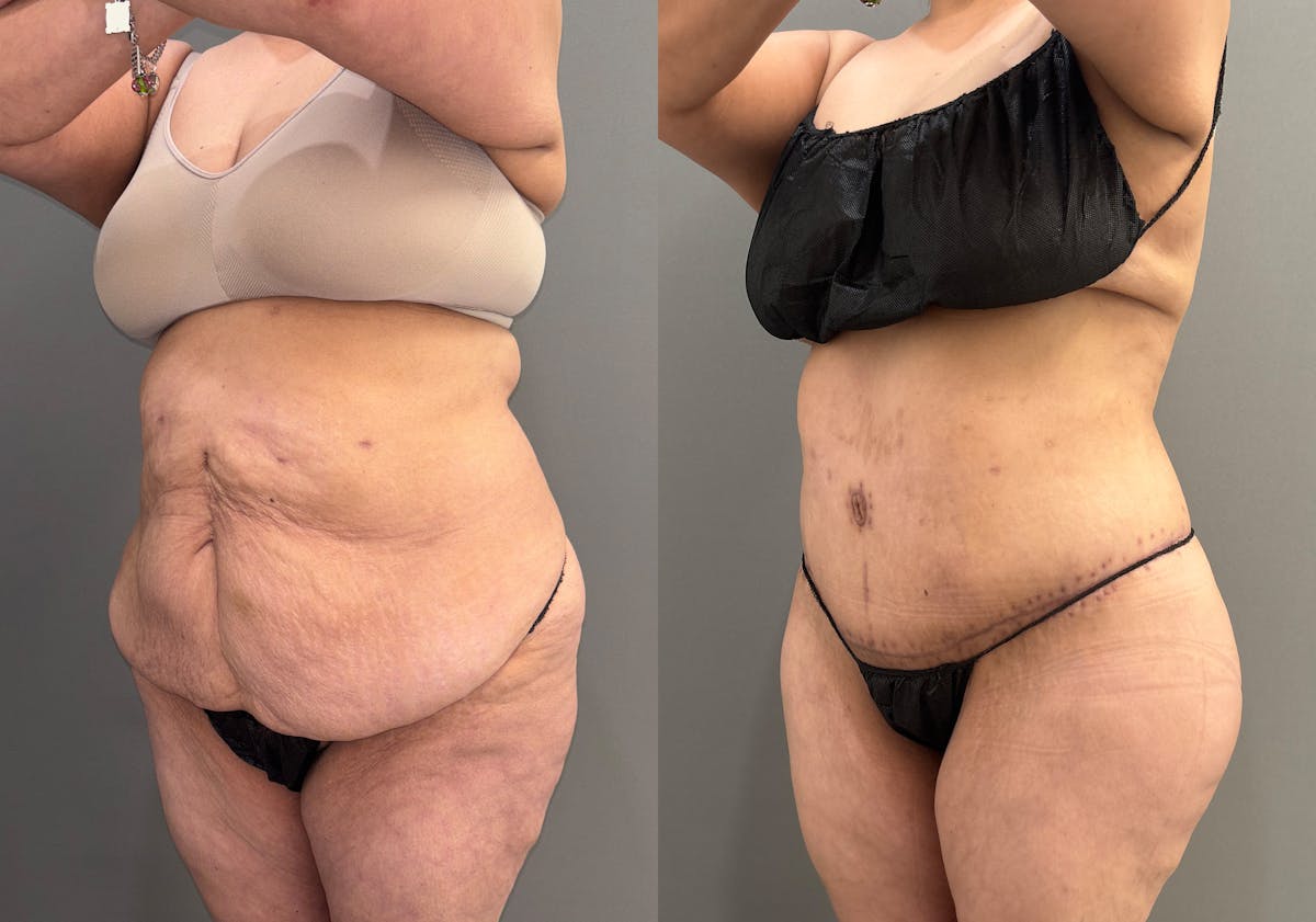 Liposuction Before & After Gallery - Patient 416071 - Image 5