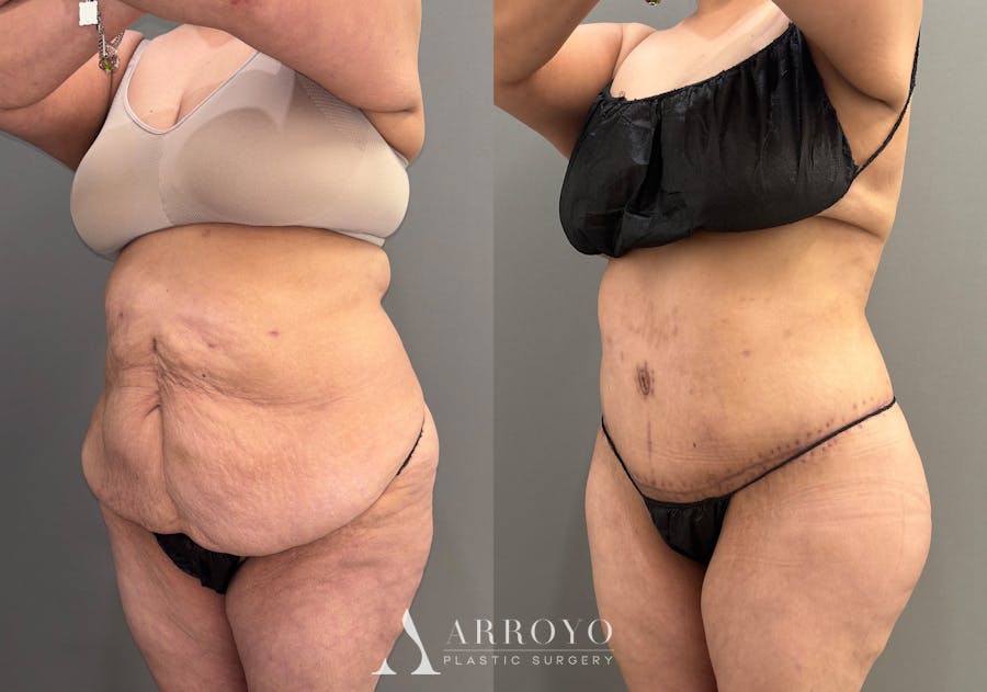 Brazilian Butt Lift Before & After Gallery - Patient 116798 - Image 5