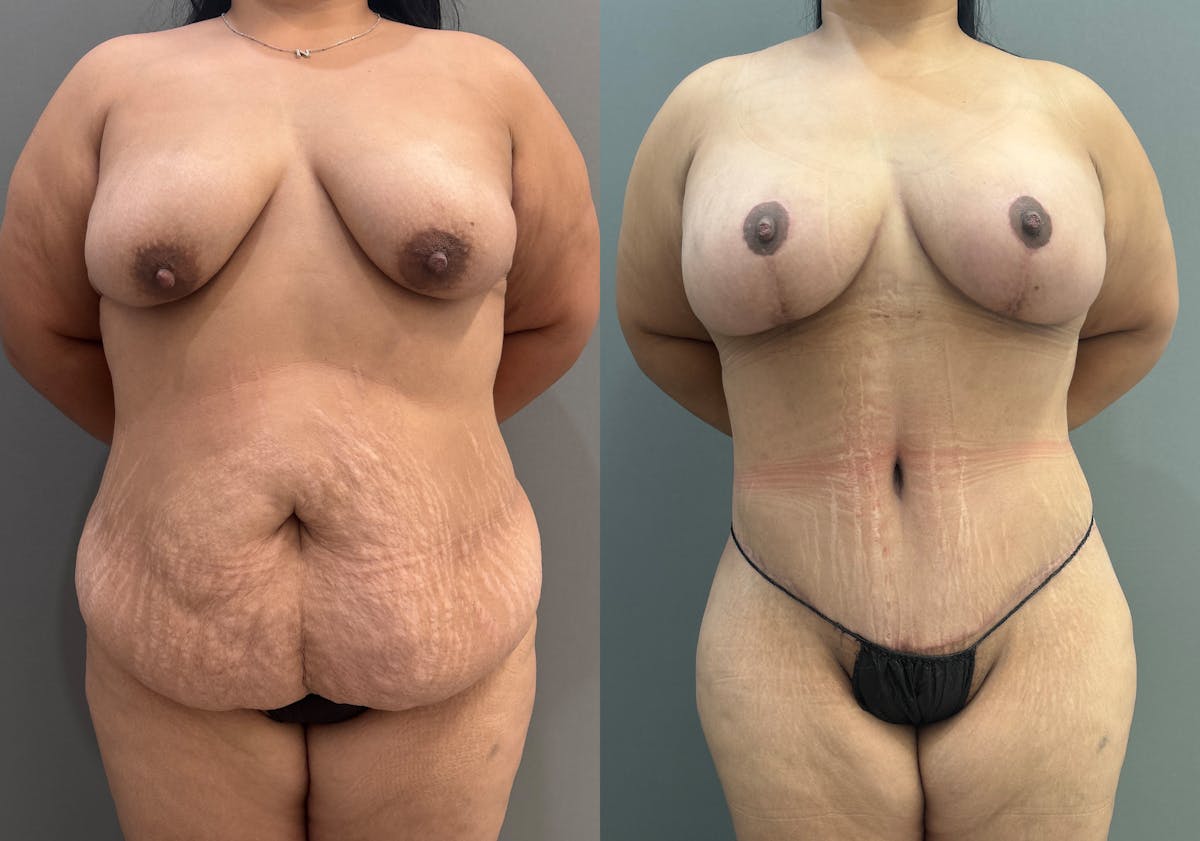 Liposuction Before & After Gallery - Patient 126136 - Image 1