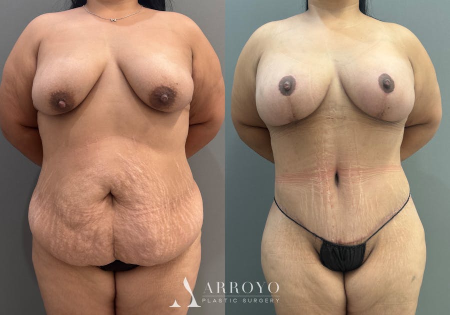 Tummy Tuck Before & After Gallery - Patient 158922 - Image 1