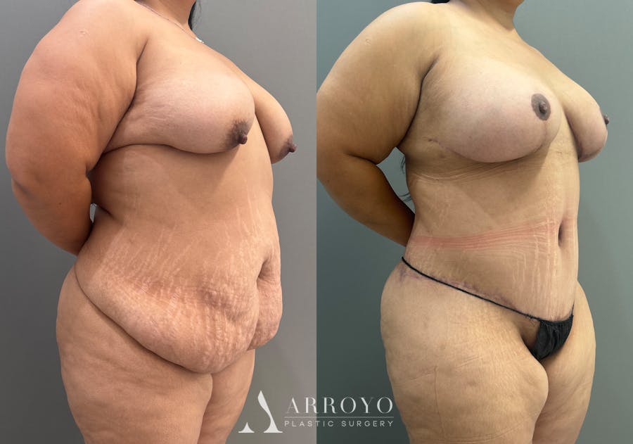 Tummy Tuck Before & After Gallery - Patient 158922 - Image 2