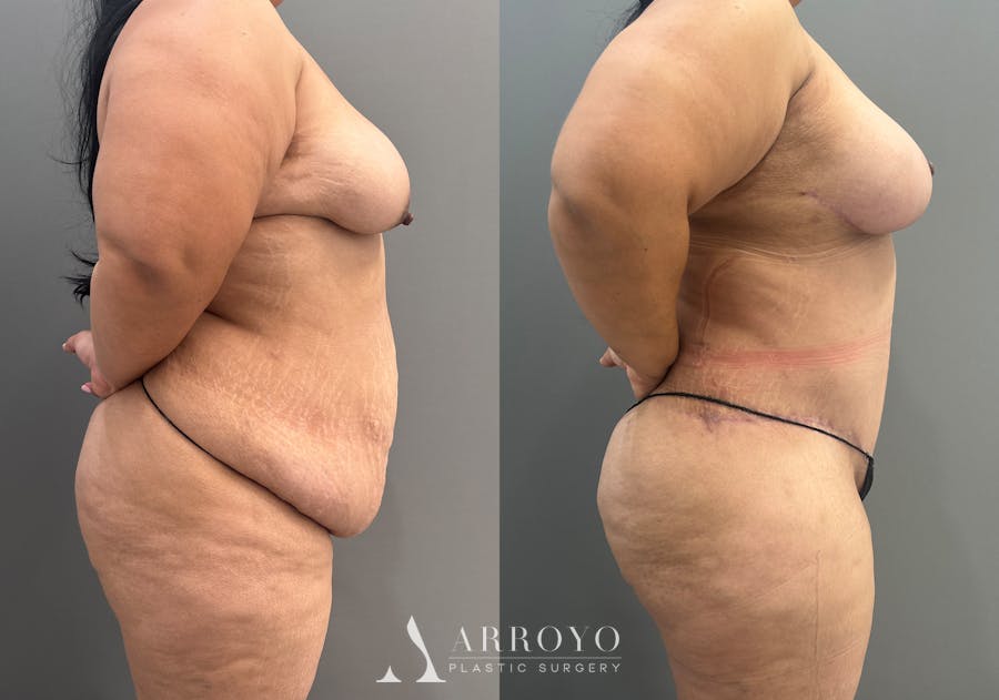 Tummy Tuck Before & After Gallery - Patient 158922 - Image 4