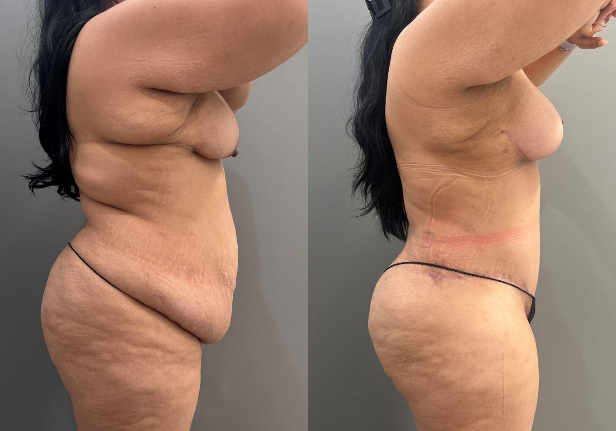 Liposuction Before & After Gallery - Patient 126136 - Image 3