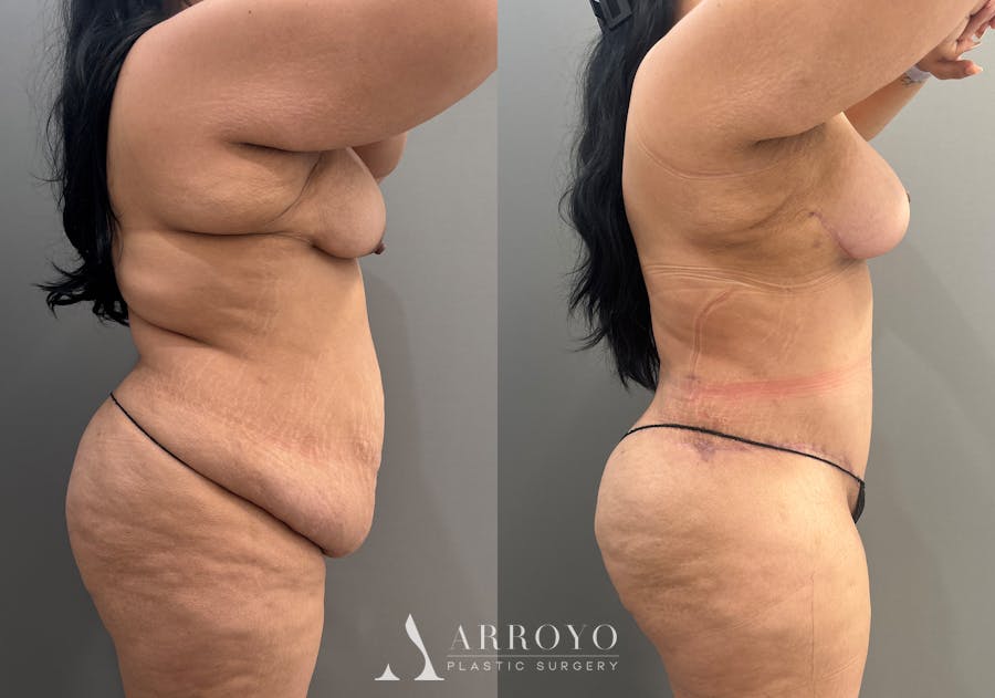 Tummy Tuck Before & After Gallery - Patient 158922 - Image 3