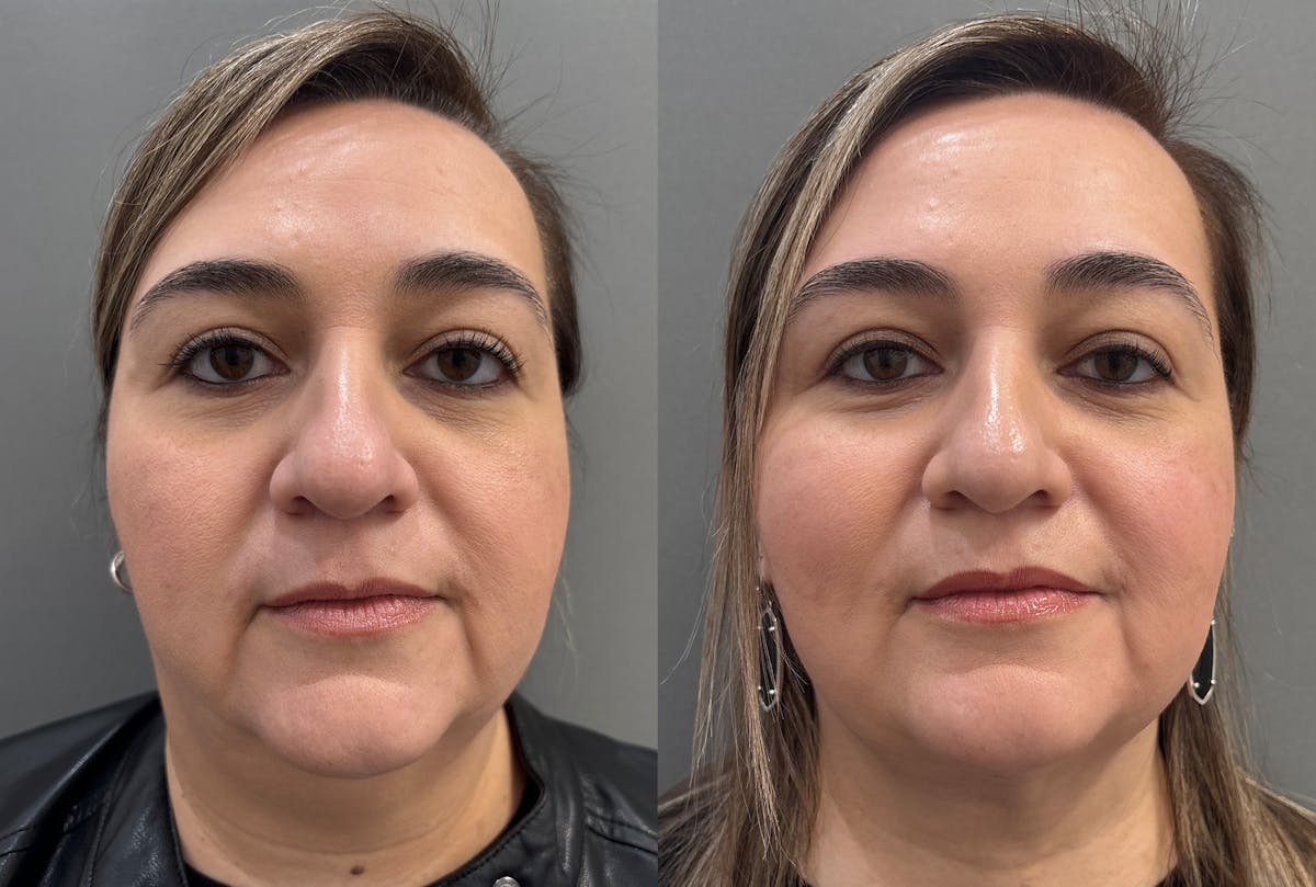 Neck Lift Before & After Gallery - Patient 262955 - Image 1