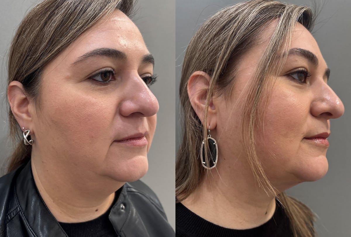 Neck Lift Before & After Gallery - Patient 262955 - Image 2