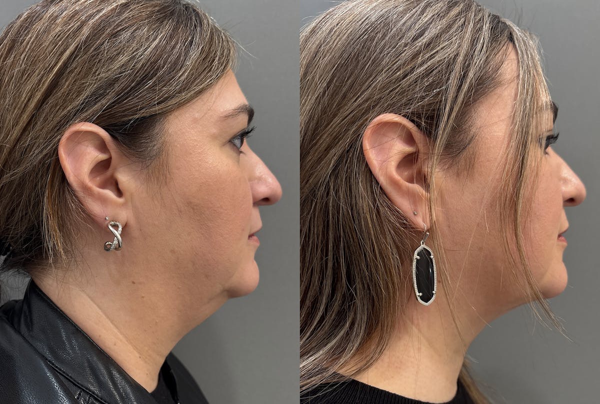 Neck Lift Before & After Gallery - Patient 262955 - Image 3